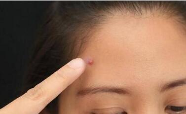 廈門祛木偶紋針的報(bào)價(jià)大概要多少錢(廈門中山醫(yī)院整形外科祛木偶紋針參考價(jià)：3720元)