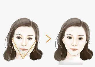 成都光電去皺紋手術(shù)價格參考標(biāo)準(zhǔn)(2023成都光電去皺紋參考價為：6495元)