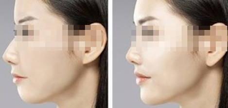 揚(yáng)州小腿水動(dòng)力吸脂價(jià)目表更新(2023揚(yáng)州小腿水動(dòng)力吸脂參考價(jià)為：5987元)