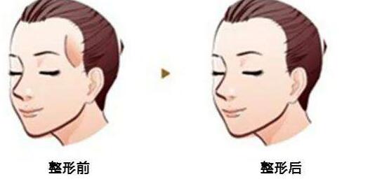 重慶顴骨顴弓修復(fù)治療價(jià)目表出爐(2023重慶顴骨顴弓修復(fù)參考價(jià)為：7006元)