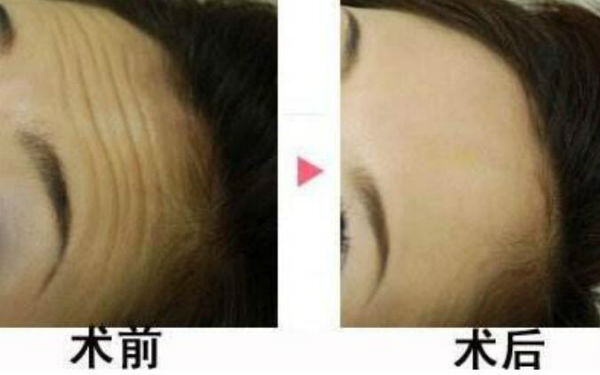 重慶無痕微雕祛眼袋價(jià)格