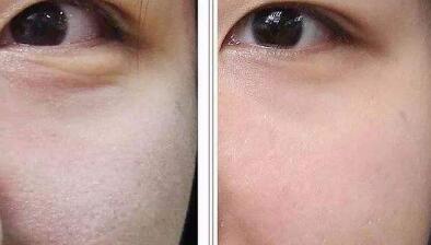 深圳嗨體注射填充唇紋費用2023公開一覽(2023深圳嗨體注射填充唇紋參考價為：5953元)