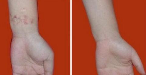 長(zhǎng)春光波祛疤印手術(shù)價(jià)格清單明細(xì)(2023長(zhǎng)春光波祛疤印參考價(jià)為：6175元)