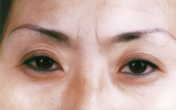 昆明電波拉皮祛靜態(tài)紋價格表大揭底(2023昆明電波拉皮祛靜態(tài)紋參考價為：5506元)