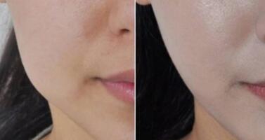 聊城冷凍溶脂瘦小腿價目表全新呈現(xiàn)(2023聊城冷凍溶脂瘦小腿參考價為：6290元)