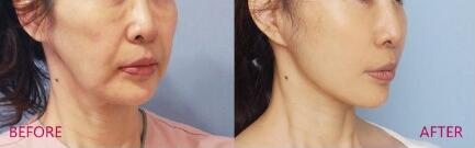 北京治療大乳頭的費(fèi)用一般需要多少錢合適(2023北京治療大乳頭參考價(jià)為：6710元)