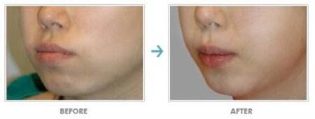 宜賓祛痘疤價格