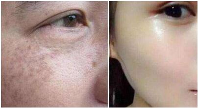 海口鼻骨歪斜矯正手術(shù)費預(yù)覽(2023?？诒枪峭嵝背C正參考價為：6385元)