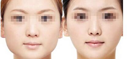 昆山溶脂針祛富貴包費(fèi)用怎樣呢(2023昆山溶脂針祛富貴包參考價(jià)為：6197元)