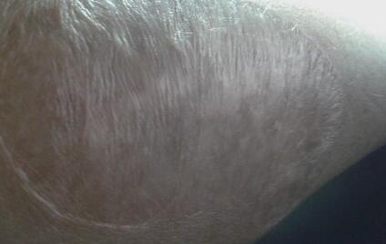 北京用玻尿酸墊鼻子收費明細公示(2023北京用玻尿酸墊鼻子參考價為：5915元)