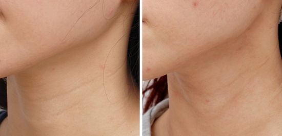 云南韓國微創(chuàng)除皺術(shù)2023價格表及相關(guān)介紹(2023云南韓國微創(chuàng)除皺術(shù)參考價為：6638元)