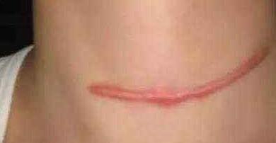 合肥假體額頭填充價(jià)格參考標(biāo)準(zhǔn)(2023合肥假體額頭填充參考價(jià)為：6426元)