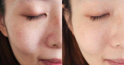 深圳電子吸脂瘦小腿價格表分享(2023深圳電子吸脂瘦小腿參考價為：6540元)