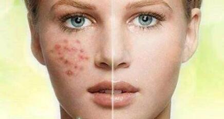 鄭州玻尿酸注射填充去痘疤要多少價(jià)格(2023鄭州玻尿酸注射填充去痘疤參考價(jià)為：6346元)