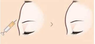 南京玻尿酸淡化口周紋手術(shù)價錢一覽表上線(2023南京玻尿酸淡化口周紋參考價為：6308元)