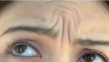 邯鄲玻尿酸注射額頭紋的費用(2023邯鄲玻尿酸注射額頭紋參考價為：6323元)