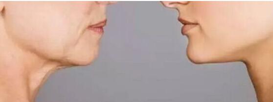 濰坊小切口去除頸部皺紋收費分享(2023濰坊小切口去除頸部皺紋參考價為：6916元)