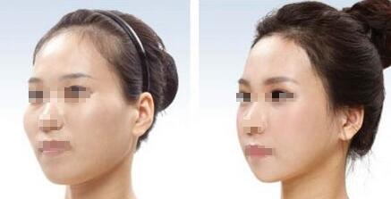 中山痘坑祛除治療價格展示(2023中山痘坑祛除參考價為：6784元)