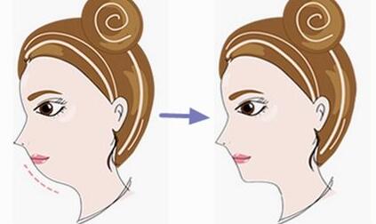 哈爾濱川字紋除皺價格表盤點(哈爾濱大韓鼻祖川字紋除皺參考價：4922元)