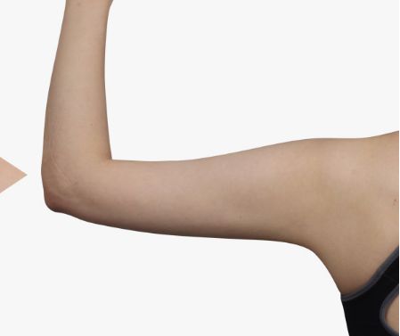 常州太陽穴填充價格