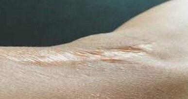 杭州光子嫩膚去斑價格多少合理(2023杭州光子嫩膚去斑參考價為：6679元)