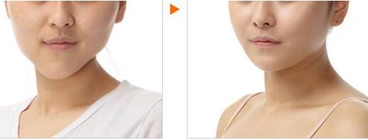 成都射頻祛除額頭紋價格大約是多少(2023成都射頻祛除額頭紋參考價為：6873元)