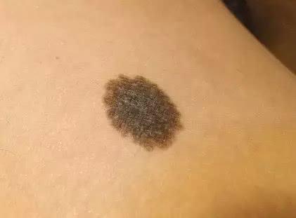 深圳超聲刀去木偶紋一次多少錢(qián)啊(2023深圳超聲刀去木偶紋參考價(jià)為：6816元)