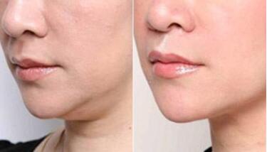 無錫無創(chuàng)激光溶脂的手術(shù)費(fèi)用需要多少錢合適(2023無錫無創(chuàng)激光溶脂參考價(jià)為：6710元)