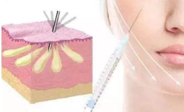 北京去皺紋法令紋價(jià)目表全新來(lái)襲(2023北京去皺紋法令紋參考價(jià)為：4361元)