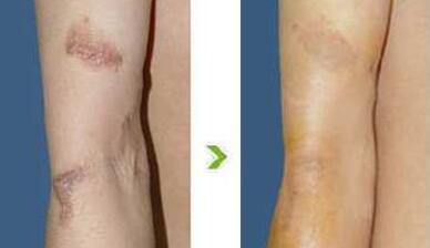 沈陽肥胖紋除皺2023價格明細表更新(2023沈陽肥胖紋除皺參考價為：6957元)