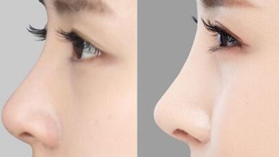 昆山眼角紋注射玻尿酸2023價格明細(xì)表公示(蘇州昆山星范整形美容醫(yī)院眼角紋注射玻尿酸參考價：3518元)