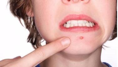 安陽鼻唇溝填充膠原蛋白價格