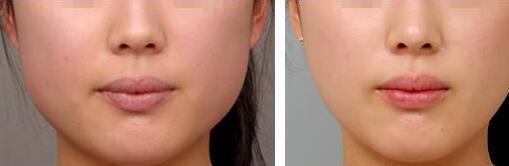 北京射頻微針去唇紋價(jià)格