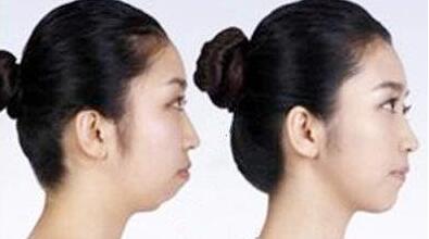 太原自體脂肪填充下巴曲線價位表明細清單一覽(2023太原自體脂肪填充下巴曲線參考價為：6776元)