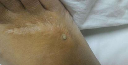 北京眼周紋注射填充費用到底需要花費多少(2023北京眼周紋注射填充參考價為：6047元)