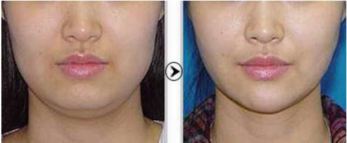 中山自體脂肪顆粒注射移植隆眉弓的價錢一般需要多少錢啊(2023中山自體脂肪顆粒注射移植隆眉弓參考價為：6796元)