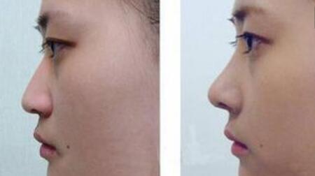 上海無創(chuàng)點陣激光去痘坑價格明細表曝光(2023上海無創(chuàng)點陣激光去痘坑參考價為：6495元)