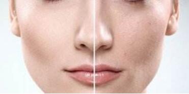 無錫紅色胎記去除價格