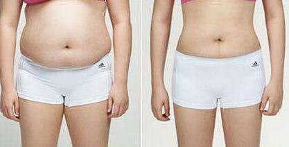 佛山激光治療頸部皺紋的價(jià)格一般需要多少錢合適(2023佛山激光治療頸部皺紋參考價(jià)為：5888元)