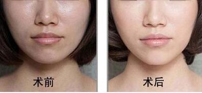 宿遷點陣射頻祛頸紋大概需要價格費用是多少啊(2023宿遷點陣射頻祛頸紋參考價為：6088元)