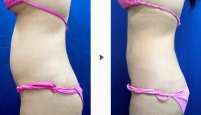 上海超聲刀祛口周紋整形價(jià)格清單明細(xì)(2023上海超聲刀祛口周紋參考價(jià)為：4282元)