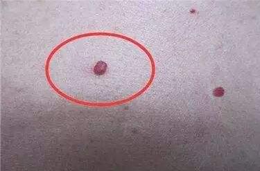 常州玻尿酸填充妊娠紋收費標準上線(2023常州玻尿酸填充妊娠紋參考價為：7101元)