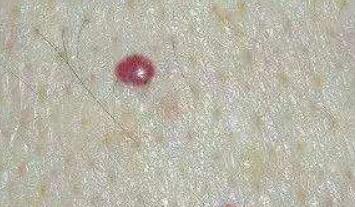 濟(jì)南內(nèi)窺鏡除皺祛魚尾紋價(jià)位表新版收費(fèi)標(biāo)準(zhǔn)一欄(2023濟(jì)南內(nèi)窺鏡除皺祛魚尾紋參考價(jià)為：6106元)