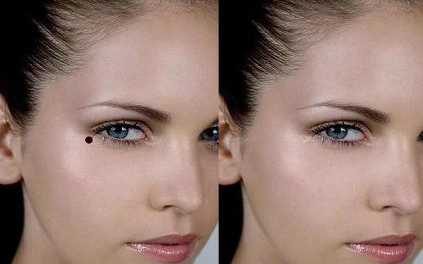 福建細(xì)紋手術(shù)祛除費(fèi)用全新上線(2023福建細(xì)紋手術(shù)祛除參考價(jià)為：6842元)