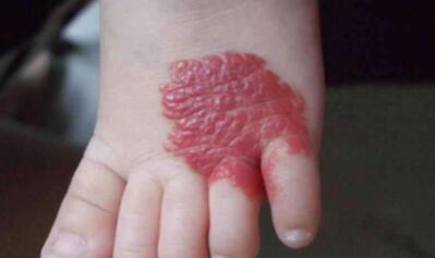 鄭州冰電波拉皮除皺的報價查詢?nèi)缦?2023鄭州冰電波拉皮除皺參考價為：6465元)