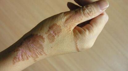 浙江激光去除曬斑應(yīng)該可以花費(fèi)多少費(fèi)用(2023浙江激光去除曬斑參考價(jià)為：5876元)