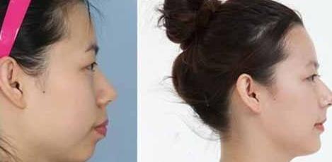 洛陽(yáng)耳軟骨隆鼻價(jià)格很高嗎(洛陽(yáng)韓美醫(yī)療美容門診部耳軟骨隆鼻參考價(jià)：4052元)