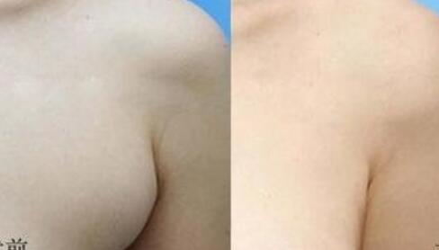 銀川翹睫毛雙眼皮價目表2023上線(銀川奧瑞蕊斯醫(yī)療美容診所翹睫毛雙眼皮參考價：6464元)