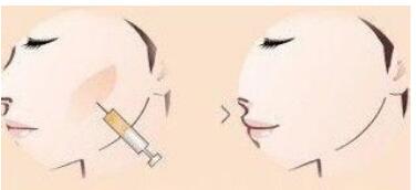 泉州注射肉毒素去動(dòng)態(tài)紋手術(shù)價(jià)格信息查詢(2023泉州注射肉毒素去動(dòng)態(tài)紋參考價(jià)為：6023元)