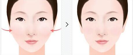 長春瘦臉整形整形價格表全面更新(2023長春瘦臉整形參考價為：7312元)